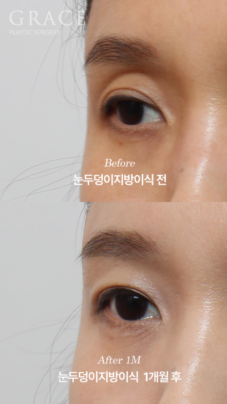 The Key to Improving Sunken Eyelids with Orbital Fat Grafting Is Placement, Not Volume image 6