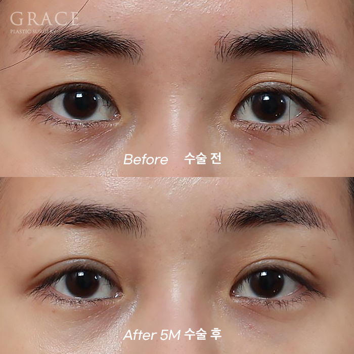 Introduction to a Case of Upper Eyelid Fat Grafting After Correction of Uneven Eyes image 1