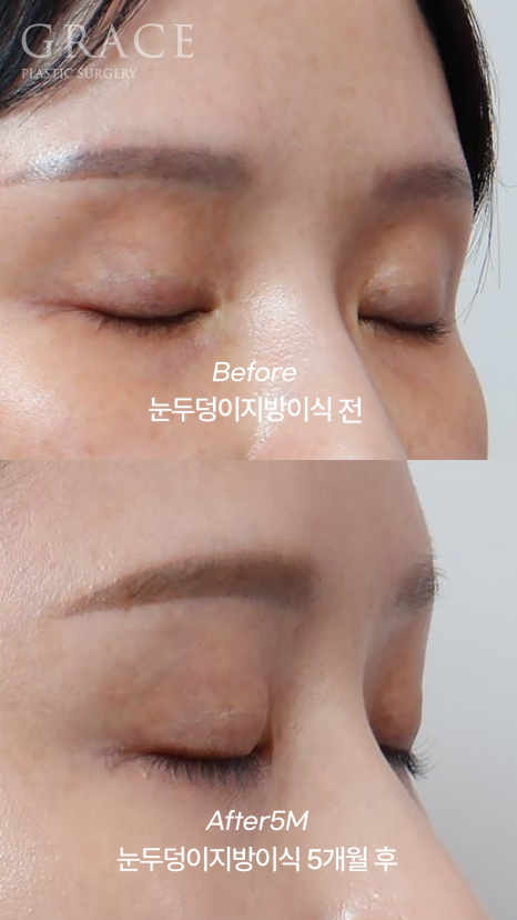 For Those Saddened by Sunken Eyelids (Upper-Eyelid Fat Grafting) image 2