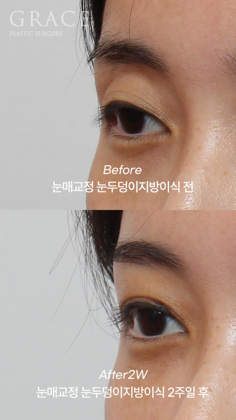 30대 눈두덩이 지방이식 + 눈매교정 + 눈밑지방재배치 BEFORE & AFTER 관련 이미지 3