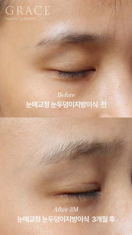 눈두덩이지방이식 붓기 언제 빠질까? 부작용&middot;유지기간까지 1주&middot;3개월&middot;6개월 변화 관련 이미지 6