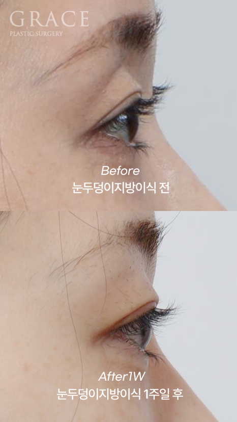 How to Fill Sunken Eyelid Hollows with Fat Grafting (Concerns About Filler Side Effects) image 6
