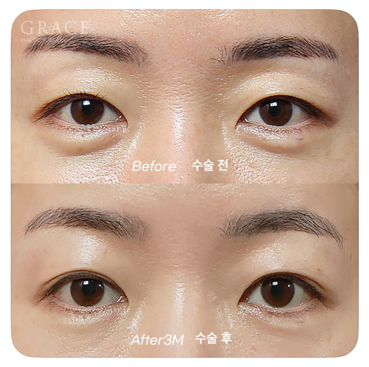 Causes of Sunken Eyelids and How Eyelid Fat Grafting Can Change Your Impression image 3