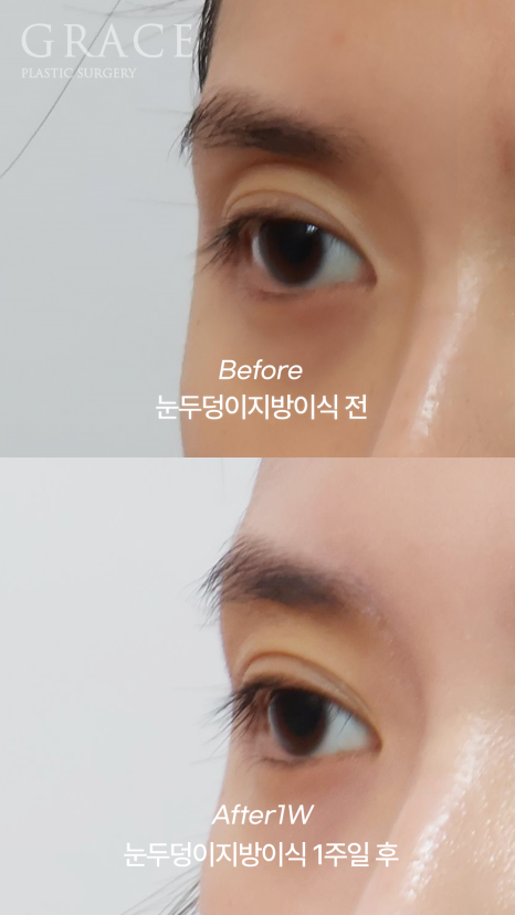 Recovery Timeline Before and After Eyelid Orbital Fat Grafting: 1 Week image 7