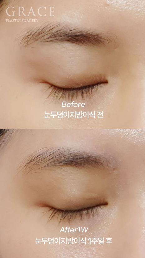 Recovery Timeline Before and After Eyelid Orbital Fat Grafting: 1 Week image 5