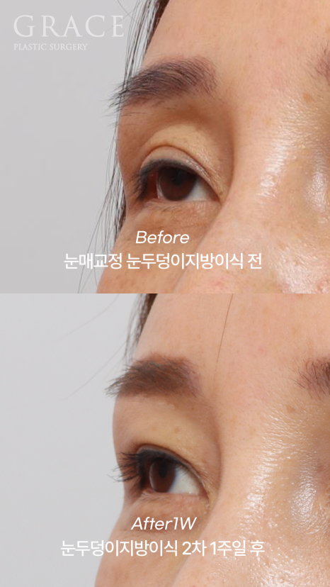 눈두덩이지방이식 2차 이식(리터치) 마취&지방채취 부위 등 관련 이미지 8