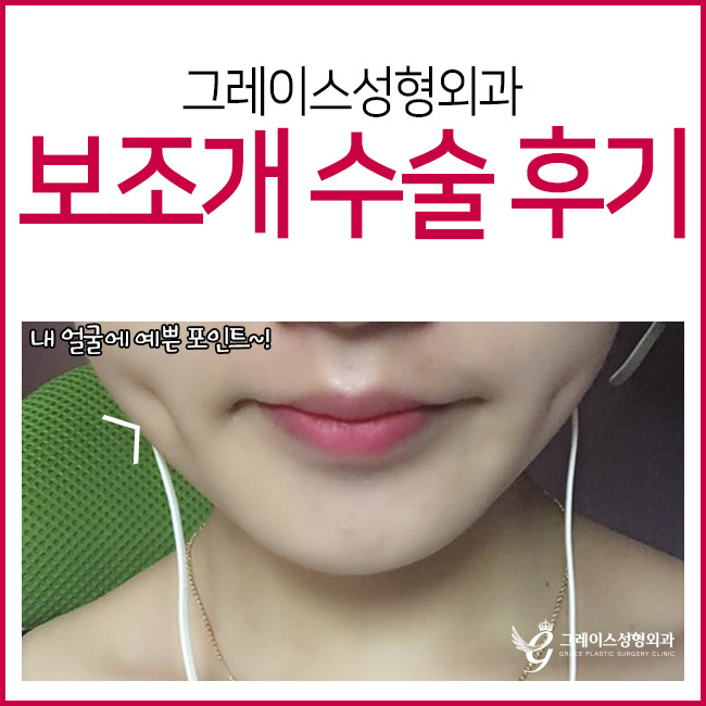 성공한 보조개수술후기를 찾고있다면? 이곳이 정답! 관련 이미지 4