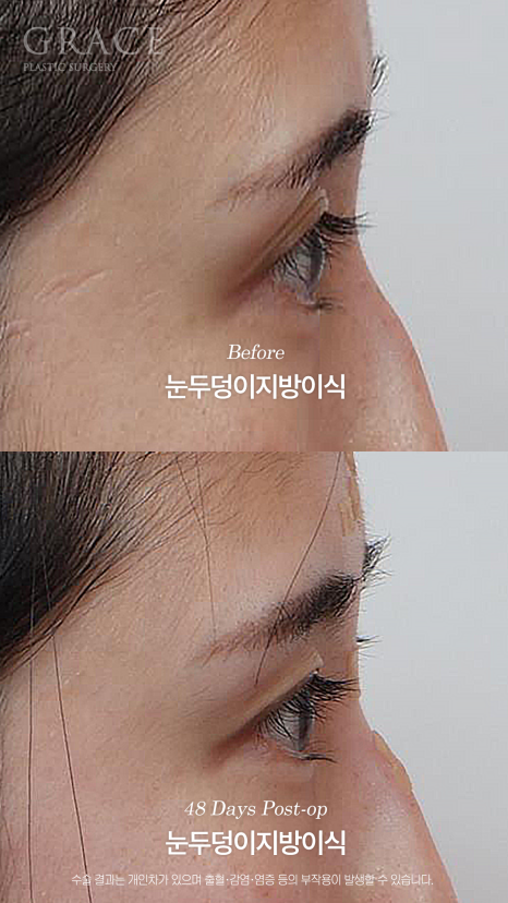 Will a Sunken Upper Eyelid Become Bumpy When You Close Your Eyes After Fat Grafting? image 15
