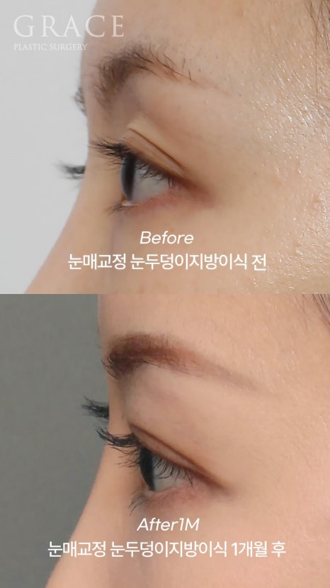 Eyebrow Hollow Fat Grafting Before and After Comparison – Gently Filling Sunken Eyes image 21