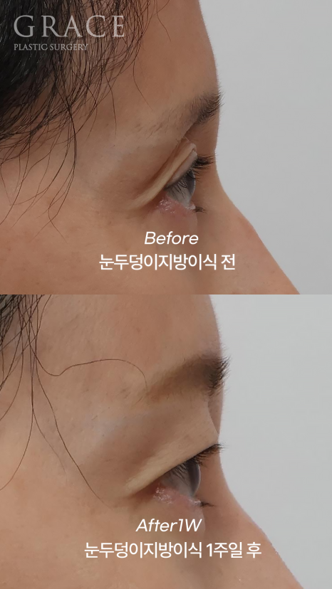 눈두덩이 지방이식 유지기간과 부작용까지 한 번에 정리 관련 이미지 7