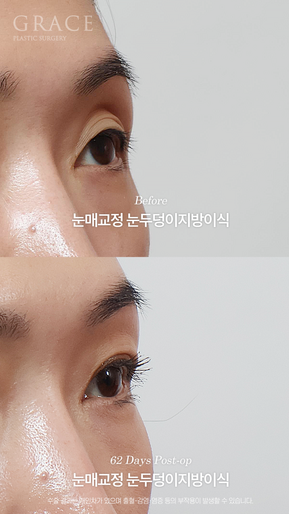 그레이스성형외과 눈두덩이 지방이식 1차로 끝내지 않은 진짜 이유 관련 이미지 5