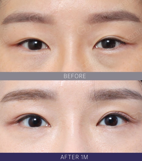 Hollow Eye Holes + Under-Eye Puffiness → (Upper Eyelid Fat Grafting + Fat Repositioning) image 7