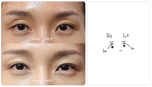Complications from Sunken Eyelid Fat Grafting? The Injection Location Determines the Result image 7