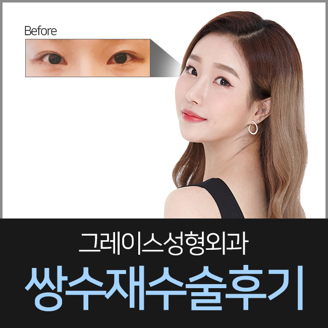 쌍수재수술후기 이곳이 정답인 이유 관련 이미지 5