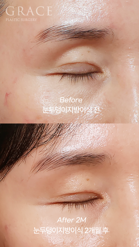 Why Do Hollow Eyelids Occur, and How Can They Be Naturally Improved? (Research Notes from a Doctor Performing Eyelid Fat Grafting) image 8