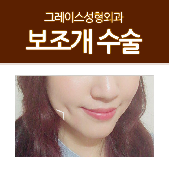 보조개수술 잘하는 곳! 그레이스성형외과 관련 이미지 5