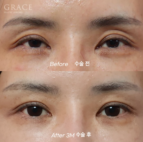 Grace Plastic Surgery’s Approach to Diagnosing Hollow Eye Socket Fat Grafting from the Structure image 2