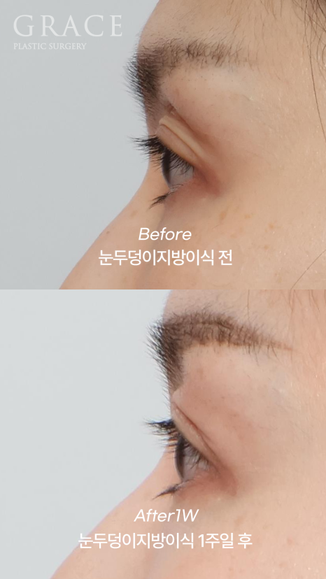 안와지방이식 꺼진 눈매를 되살리는 아이홀 꺼짐 솔루션 관련 이미지 5