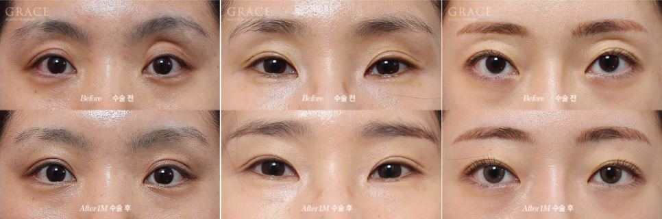 3 Things You Must Know Before Eyelid Fat Grafting image 2