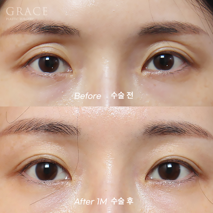 Hollow Eye Holes + Under-Eye Puffiness → (Upper Eyelid Fat Grafting + Fat Repositioning) image 1
