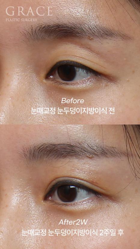 30대 눈두덩이 지방이식 + 눈매교정 + 눈밑지방재배치 BEFORE & AFTER 관련 이미지 2