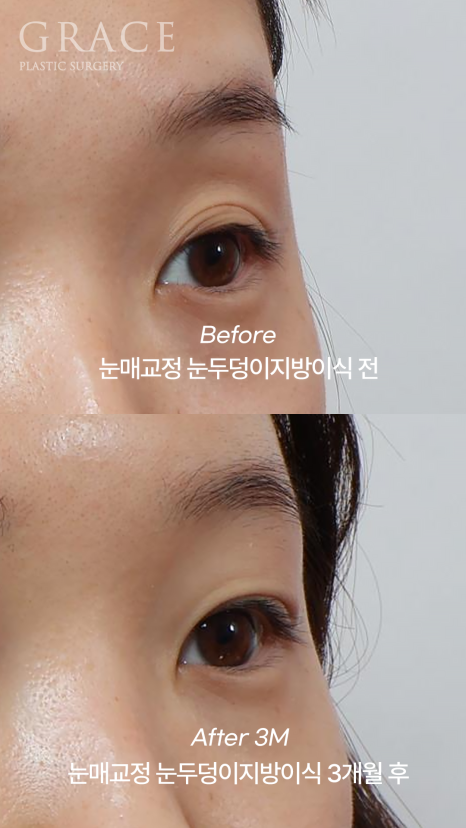 30대 눈꺼풀 꺼짐 교정 눈두덩이지방이식과 비절개눈매교정으로 자연스럽게 복원된 눈매 관련 이미지 5