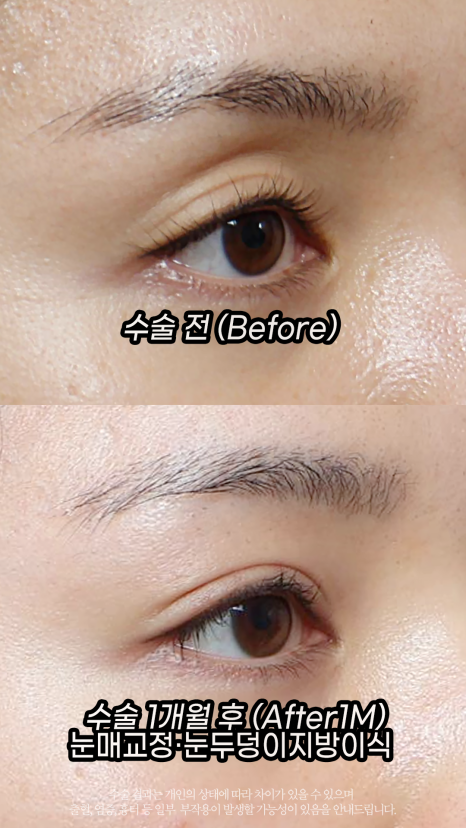 Eyelid Fat Transfer (eyelid fat transfer) Grace Plastic Surgery image 3
