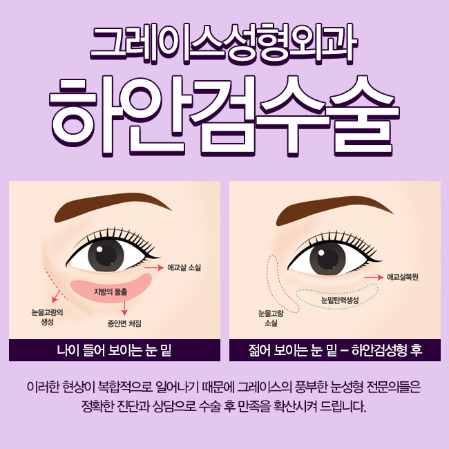 눈 밑 지방의 돌출, 그레이스성형외과 하안검수술로 해결! 관련 이미지 2