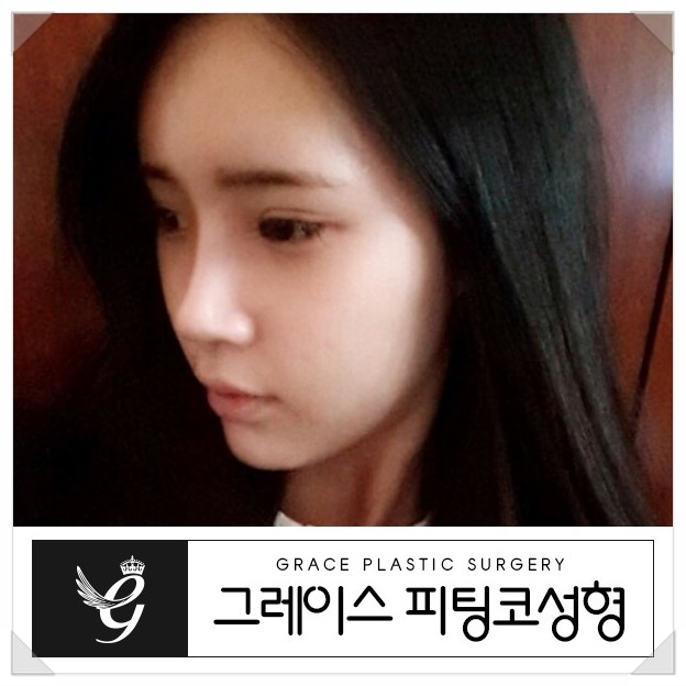 코성형의 혁명, 그레이스성형외과 피팅코 관련 이미지 1
