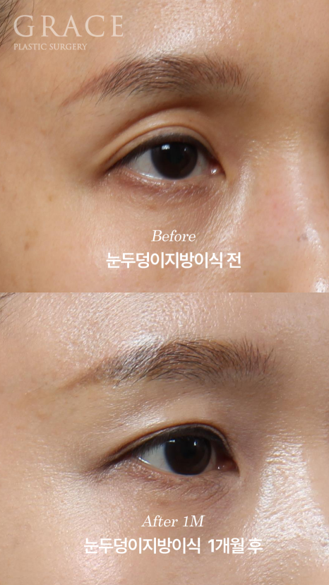 The Key to Improving Sunken Eyelids with Orbital Fat Grafting Is Placement, Not Volume image 4