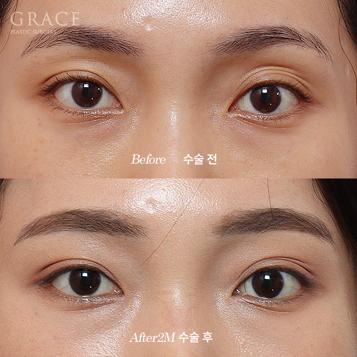 Why It’s Not Always Better Just Because Lower Eyelid Fat Grafting Is Cheap image 8