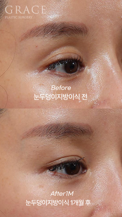 Why Injecting Fat Into the “Orbital Fat” Is Important in Sunken Eye Fat Grafting (dr.essay) image 2
