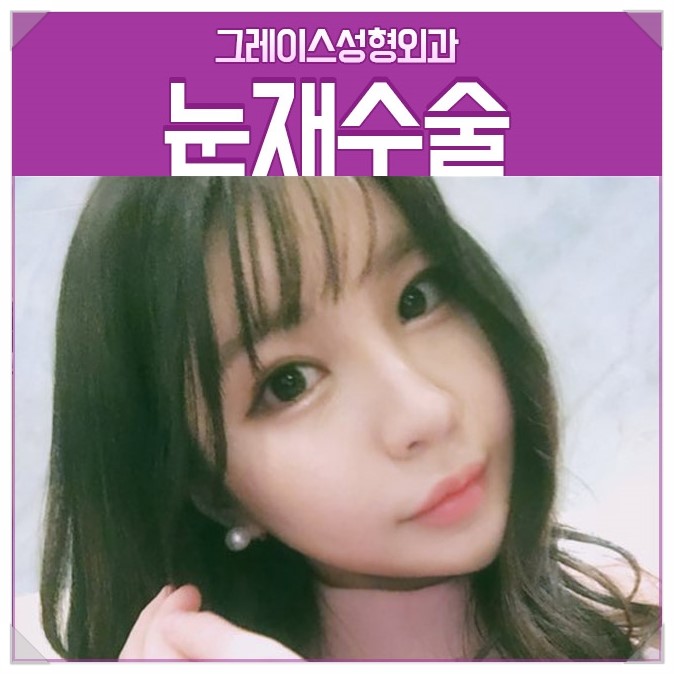 눈재수술 그레이스성형외과에서 알아보기! 관련 이미지 4