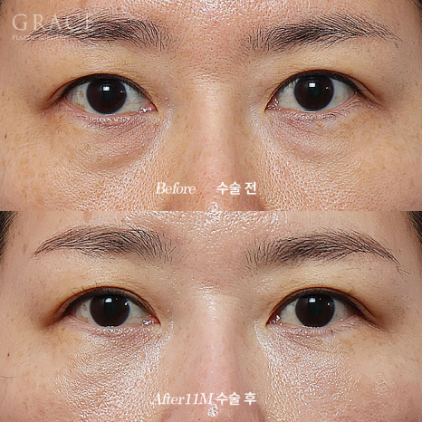 Side Effects of Under-Eye Fat Repositioning? Common Traits of People Who Say It Went Wrong image 7