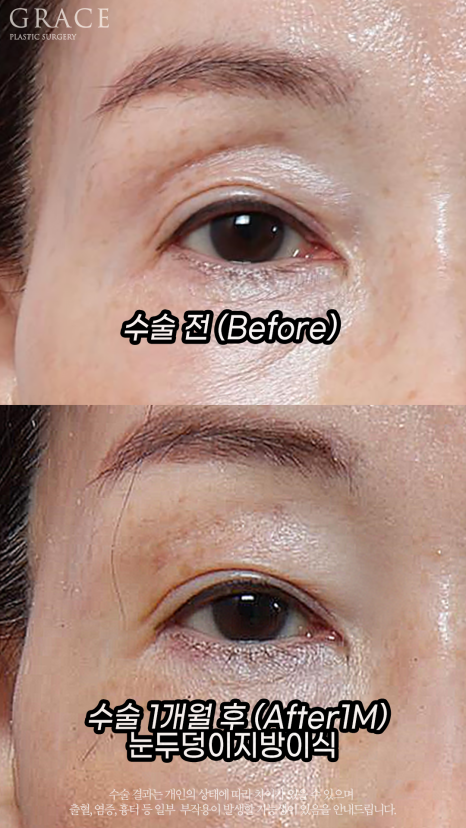 눈두덩이 지방이식으로 젊음을 되찾다: 70대, 40대 시술 전후 비교 관련 이미지 3