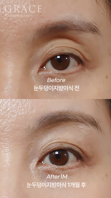 눈꺼풀 지방이식 보법이 다른 최문섭 원장님 실력 관련 이미지 4