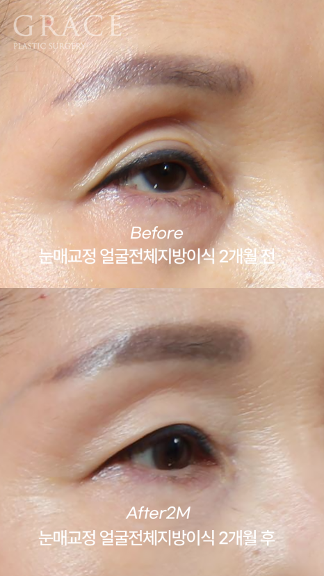 In Your 50s, Restoring a Youthful Look with Before-and-After Eye Surgery and Fat Grafting to the Upper Eyelids, Temples, Under-Eyes, and Above the Brows image 4
