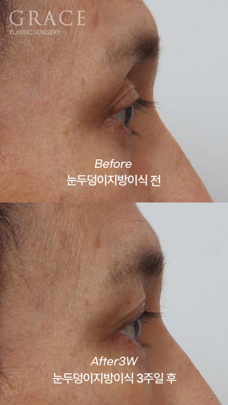 When the Eye Hollows Sink In, You Look Tired: Swelling After Fat Grafting for Men’s Eyes image 7