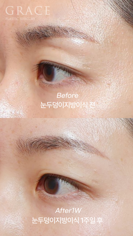 Eyebrow Fat Grafting &middot; Eyelid Fat Grafting &middot; Sunken Eyes Surgery Cost Information (As of June 2025) image 3