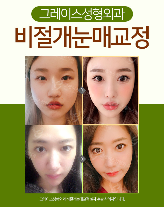 안검하수눈매교정 또렷하고 선명한 인상! 관련 이미지 3