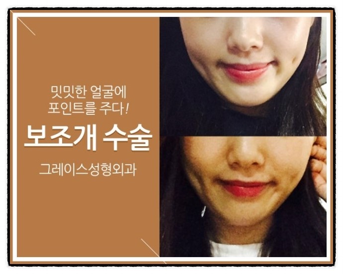 밋밋한 얼굴에 뽀~인트! 그레이스성형외과 보조개 수술 관련 이미지 2