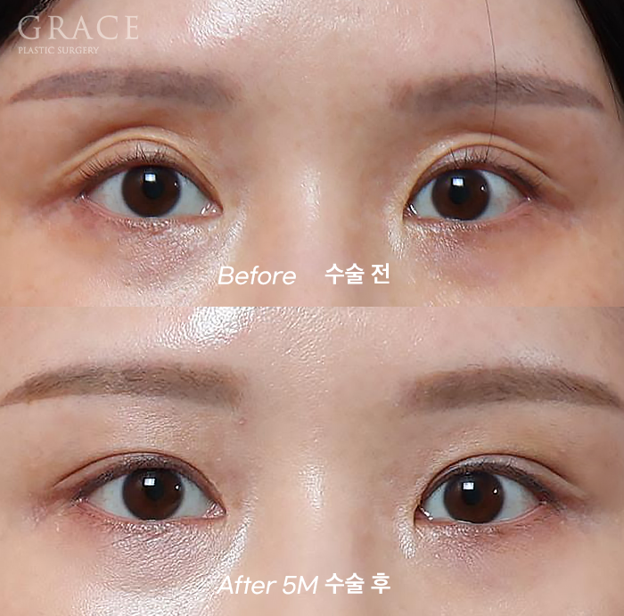 For Those Saddened by Sunken Eyelids (Upper-Eyelid Fat Grafting) image 4