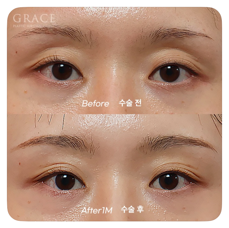 Causes of Sunken Eyelids and How Eyelid Fat Grafting Can Change Your Impression image 4