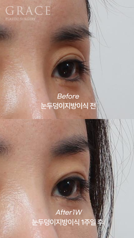 Week 1 After Upper Eyelid Fat Grafting in the Mid-40s: A Natural Return Without Swelling image 8