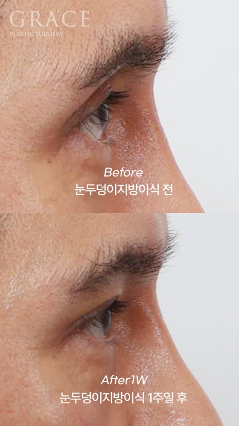 Male Brow Filler? Improvement with Eye-Hole Fat Grafting (Without Worrying About Side Effects, Scars, or Swelling) image 3