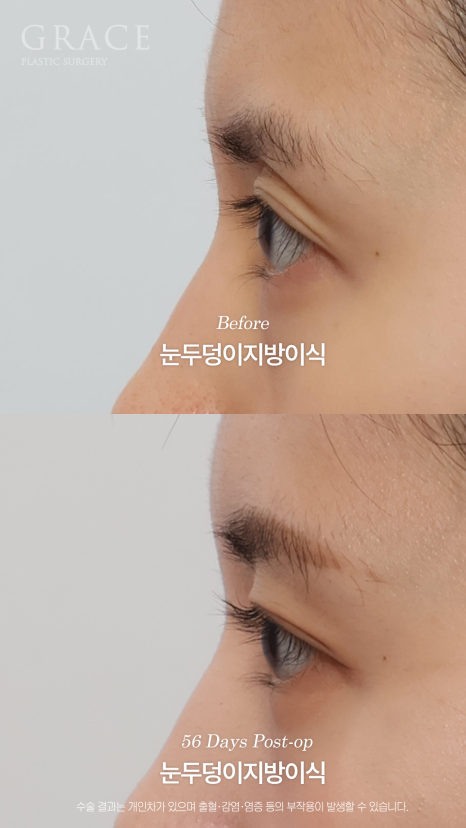 가을 되니 유독 퀭해 보이는 눈가 걱정? 눈두덩이 지방이식 56일차 관련 이미지 5