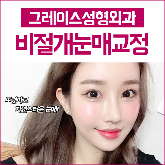 비절개눈매교정가격 또렷하고 자연스러운 눈매 관련 이미지 4