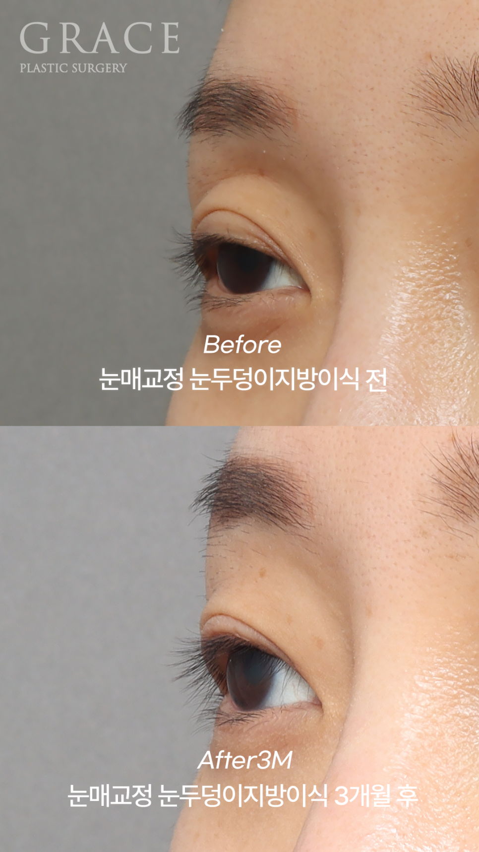 실패한 돌출눈성형 (눈매교정과 눈두덩이 지방이식) 관련 이미지 1