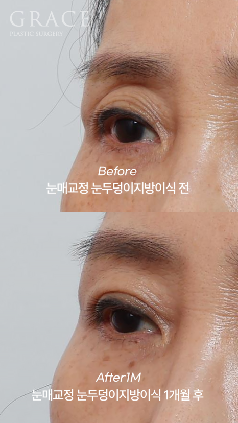 Is Upper Blepharoplasty Necessary at 58? Swelling Side Effects After Non-Incisional Ptosis Correction and Upper Eyelid Fat Grafting image 6