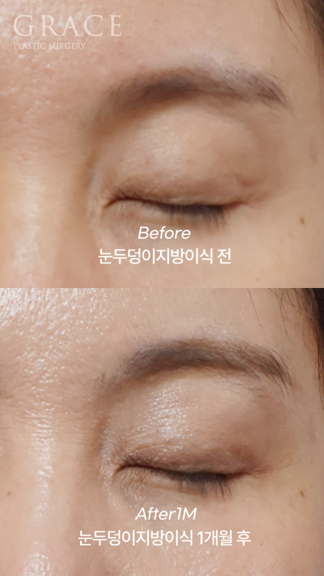 눈꺼풀 지방이식 보법이 다른 최문섭 원장님 실력 관련 이미지 3